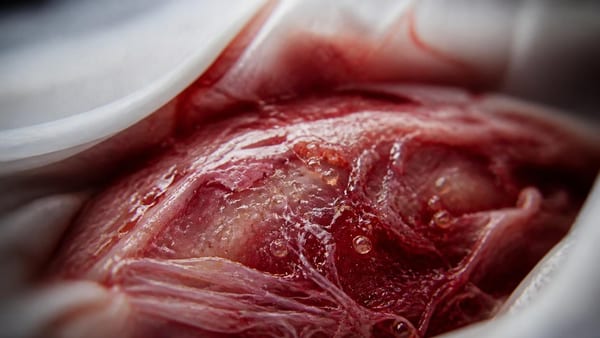 Medicina rigenerativa per la terapia avanzata delle ulcere vascolari